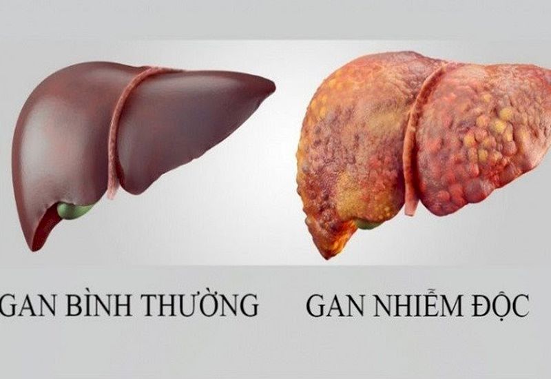 Tại sao gan bị nhiễm độc?