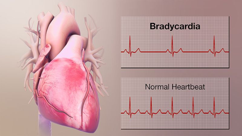 Tim đập chậm là gì?